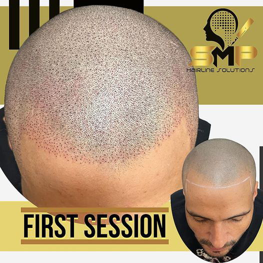 Scalp Micropigmentation San Antonio